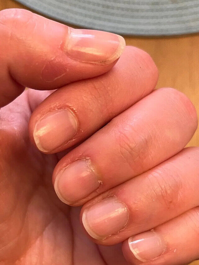 नाखून की चमड़ी के दर्द को ठीक करने के उपाय | Tips To Treat Cuticle Peeling